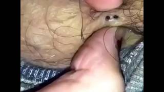 Выдавливание черных угрей, точек Squeezing blackheads