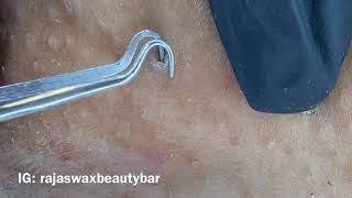 After Brazilian Wax Ingrown Hair Removal!!