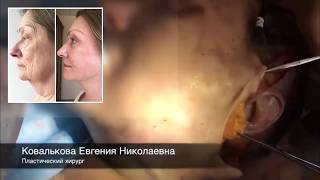 Операция SMAS-лифтинг