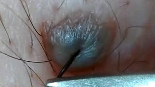 ほくろの毛を引っこ抜く！part8 Hair of a mole!