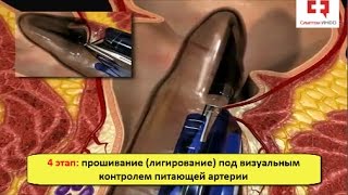 Лечение геморроя без операции - техника дезартеризации геморроидальных узлов и геморроидопексия