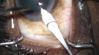 fellow case 4 trabectome phaco part 2 good opening of Schlemm's canal then soft lens stop and chop