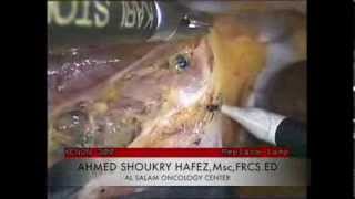 THORACOSCOPIC ESOPHAGECTOMY. استئصال المرئ بالمنظار الجراحي .دكتور احمد شكري حافظ