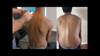 علاج فقرات الظهر كاملة  وارجاعها لمكانها بدون جراحه فقط بالطقطقه |د/لان