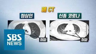 하얗게 변한 폐…우한 코로나 '치명적 폐 손상' 확인 / SBS