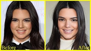 Kendall Jenner Before & After Plastic Surgery! + (Leaked Photos)
