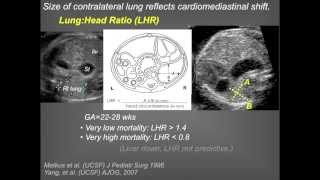 UCSF Radiology: A New Challenge: Congenital Diaphragmatic Hernia (CDH)