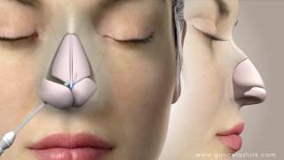 Rhinoplasty (Nose Job) Video Animation - Guncel Ozturk, MD