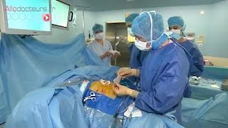 Calculs biliaires : l'ablation de la vésicule (cholécystectomie) - Allô Docteurs