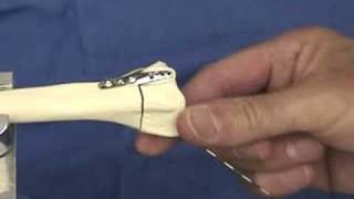 Radial and Ulnar Pin Plate™