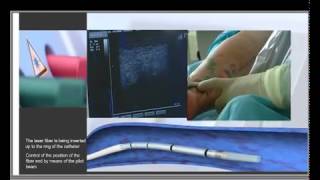 Эндовенозная лазерная коагуляция вен с QuadroStraPRO от Asclepion