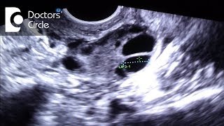What is a good mature follicle size for IUI? - Dr. Ashwini S G