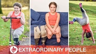 Amputee Defies Meningitis To Become Sports Superstar