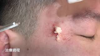 微創超大臉部粉瘤清除 美麗新城診所莊禮謙醫師 Minimal incision, Big Epidermal Cyst, Dr George