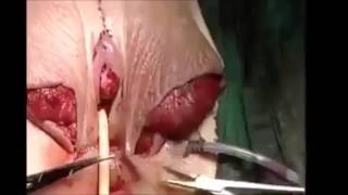 change sex surgery  , male turned  to female by operation