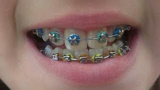 Brackets Paso a Paso - Ma01rp