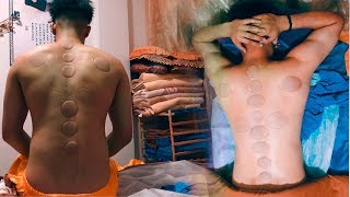 TRIED CUPPING AND THIS HAPPENED? Manipuri vlog