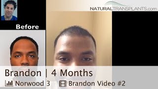 African American Hair Loss Treatment Update | African American Hair Loss Male (Brandon)