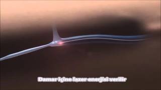 Lazerle Varis Tedavisi, Uzm. Dr. Rengin Türkgüler