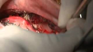 Lefort Osteotomy