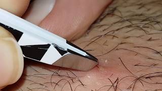 Plucking infected hair follicle