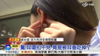 驚!耳環扣不見 竟是被耳垂吃掉了│中視新聞20160525