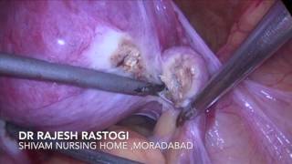 TLH DIDELPHIC UTERI by Dr Rajesh Rastogi