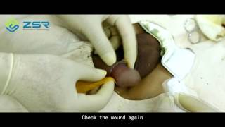 ZSR Circumciser operation video