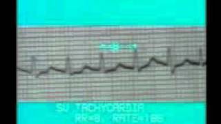 Learning ECG - ATRIAL RHYTHM