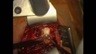 ACDF Part 1