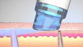HydraFacial (ХидраФейшъл) терапия за лице