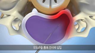 L'DISQ C 경추용
