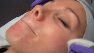 Chemical Peel:SkinMedica Vitalize Peel:Bentkover Facial Plastic Surgery:A Daily J