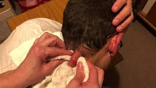 Retirando Berne do meu Pescoço | Removing the Dermatobia Hominis worm from my Neck