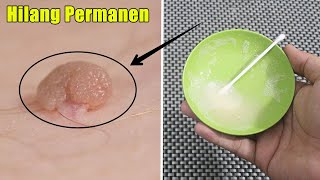 HANYA PAKAI INI, SKIN TAG ATAU BOLA-BOLA DAGING DI LEHER DAN BADAN LENYAP