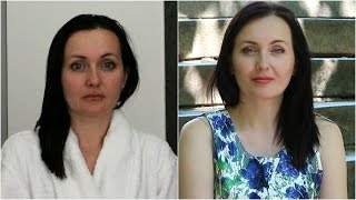 RF-лифтинг. После 2-х процедур / Lifting Anti-Age