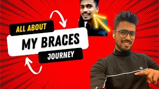 I Am DONE With My BRACES!!! (BEFORE and AFTER Treatment results)