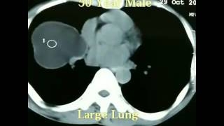 Large Lung Hydatid Cyst