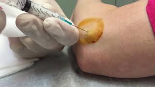 You Can't Unwatch This, Treatment of Tennis Elbow
