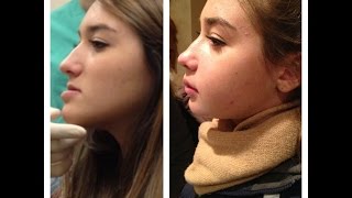 Double Jaw Surgery - my story & tips!