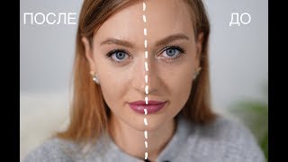 Как убрать синяки под глазами?