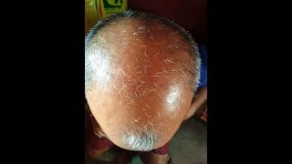 Jonk Ka Tel - The Best Hairfall Treatment