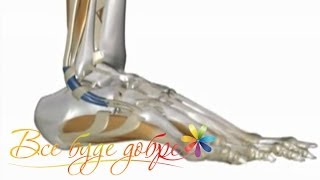 Профилактика плоскостопия - Все буде добре - Выпуск 361 - 24.03.14 - Все будет хорошо
