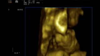 УЗИ 32 недели - мальчик sonogram 32 week - boy