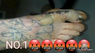 FULL TOE AMPUTATION STITCH REMOVAL AND SCAB PULLING DISGUSTING DISFIGUREMENT AFTER BOTCHED BUNION SU