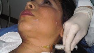 Plasma Rico en Plaquetas o PRP para la flacidez ojeras y cicatrices