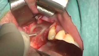 SL2 Implants by Lateral Sinus Lift