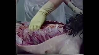 อสุภะกรรมฐาน : ความสกปรกของร่างกาย ชันสูตรศพ 4