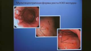G03Малихова ОА Нейроэндокринные опухоли желудка Алгоритм диагностики и ведения пациентов