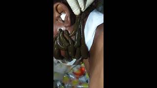 Leech therapy in cancer patient by vaidya akshay chauhan